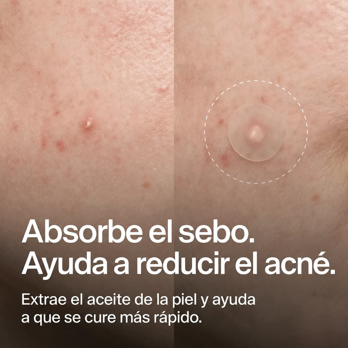 clear-dots-acne-patches gallery 2 (es)