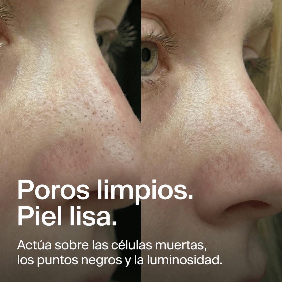 nose-patches gallery 5 (es)