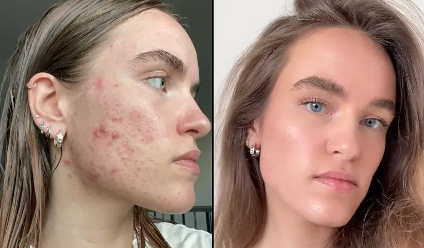 Dana antes y después de 8 semanas con Clear+