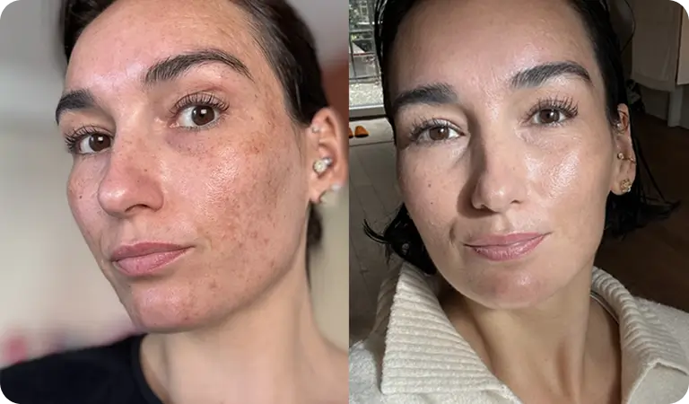 Esza antes y después de 10 semanas con Clear+