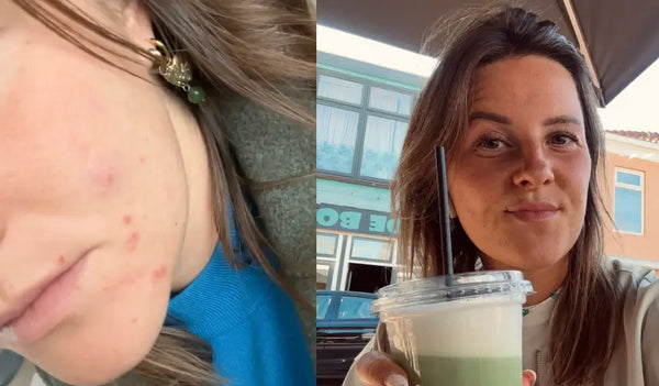 Na de pil stoppen explodeerde mijn huid.