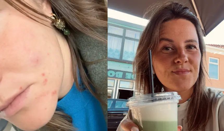 Gaby antes y después de 12 semanas con Clear+