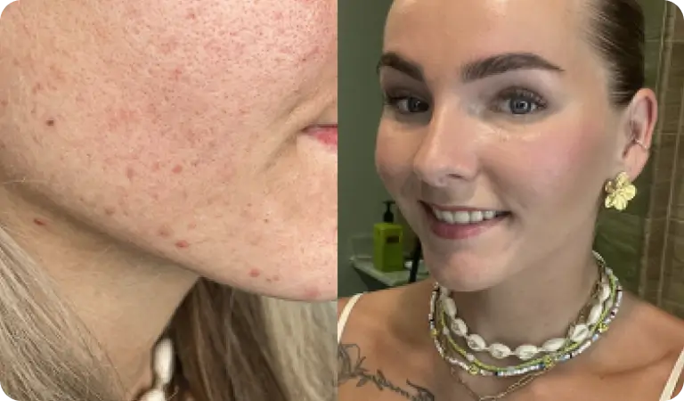 Joy antes y después de 8 semanas con Clear+