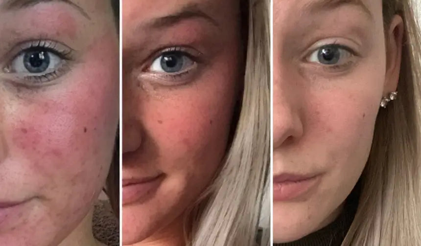 Lisa antes y después de 7 semanas con Clear+
