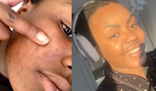 Het begon met minder talg