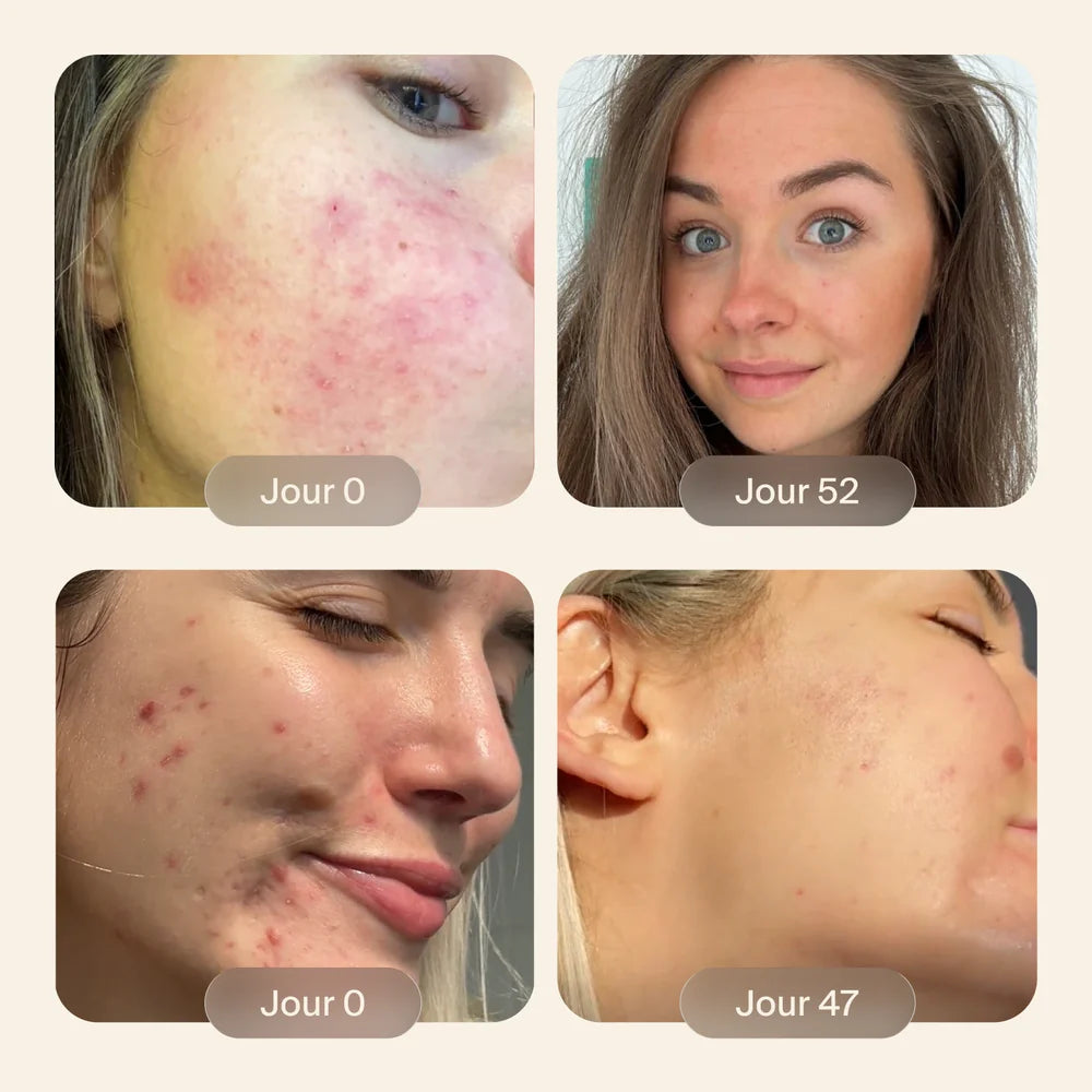 Quatre vraies transformations avant/après de clientes Cloudless Clear+ — résultats de la semaine 2 à la semaine 12