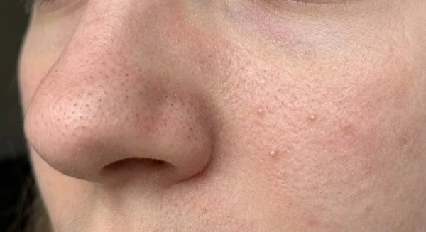 Blackheads or whiteheads
