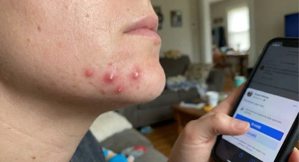 Painful or cystic bumps
